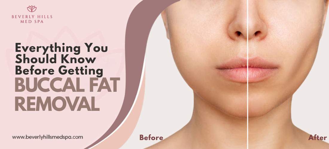 Everything You Should Know Before Getting Buccal Fat Removal